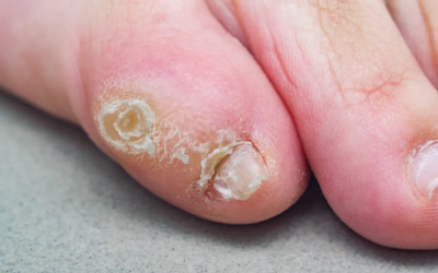 3 Effective Ways To Treat Ingrown Toenails