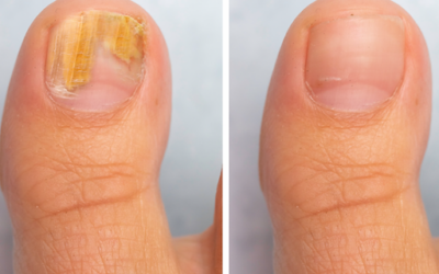 Understanding and Treating Nail Fungal Disease