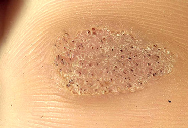 foot wart removal by podiatrist johannesburg