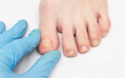 The Complete Guide to Preventing Ingrown Toenails