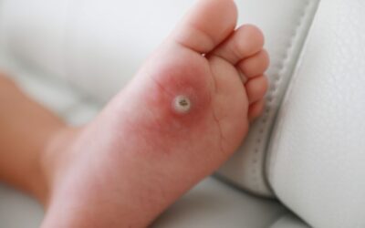 Staying Active and Wart-Free: Foot Health Tips for Gym Enthusiasts