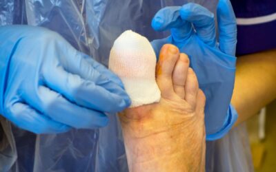 Conservative vs Surgical Ingrown Toenail Treatment: Which Is Right for You?