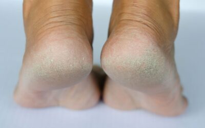 Understanding and Treating Cracked Heels: A Complete Guide